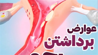 عوارض برداشت رحم