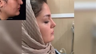جراحی بینی طبیعی