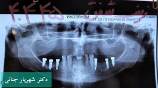 ایمپلنت دندان ها