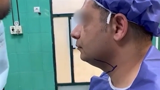 ساکشن غبغب و پروتز چانه برای آقا