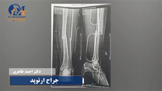 فیلم جراحی شکستگی ساق پا