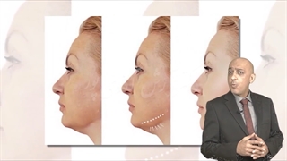 لیپوساکشن غبغب