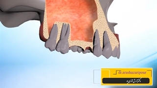 جراحی سینوس