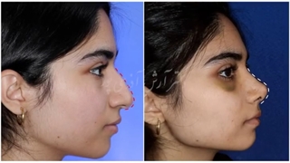 جراحی زیبایی بینی