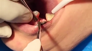 جراحی ایمپلنت دندان