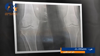 فیلم رضایت بیمار از تعویض مفصل زانو