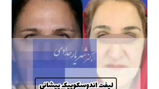 لیفت اندوسکوپیک پیشانی