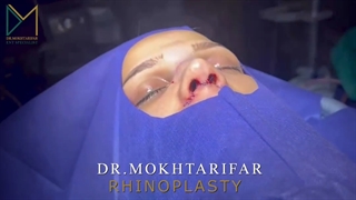 قبل و بلافاصله و یک ماه بعداز جراحی برای مراجعه کننده عزیزمون از بروجرد