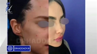 جراحی بینی