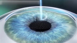 عمل فمتولیزیک جدیدترین روش لیزر چشمی