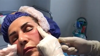 جوانسازی صورت با ماندگاری بالا