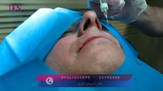تزریق ژل برای لب آقایان