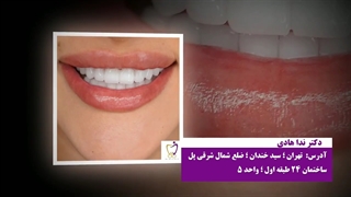 اصلاح طرح لبخند
