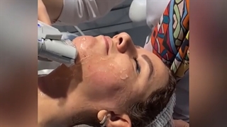 هایفوتراپی معجزه جوانسازی و لیفت صورت