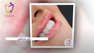 اصلاح طرح لبخند