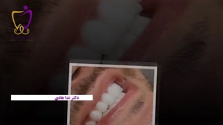 اصلاح طرح لبخند