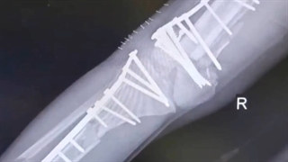 فیلم جراحی درمان شکستگی شدید استخوان پا