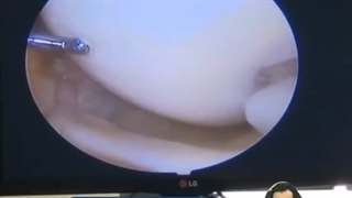 فیلم جراحی پارشیل مینیسککتومی به روش آرتروسکوپیک