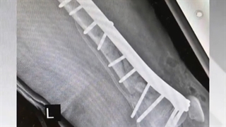 فیلم درمان شکستگی زانو خرد شده