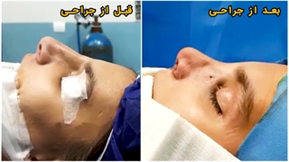 راینوپلاستی بعد از سقوط از ساختمان