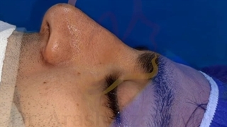 راینوپلاستی