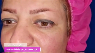 بلفاروپلاستی