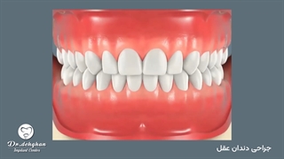 دکتر وحید دهقان : جراحی دندان عقل