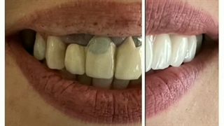 تجربه اصلاح طرح لبخند داشتی ؟