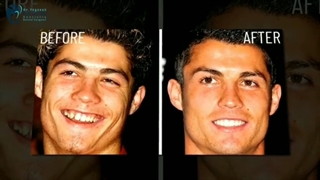 اصلاح لبخند در چهره افراد معروف