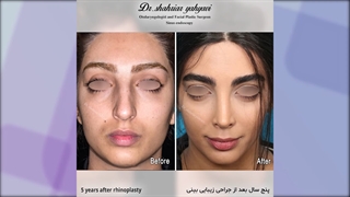 پنج از سال پس از جراحی زیبایی بینی