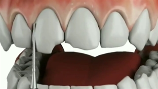 کامپوزیت برای اصلاح طرح لبخند