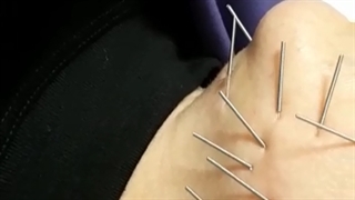 جوانسازی و شادابی با طب سوزنی