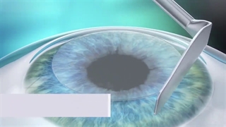 جراحی حذف عینک (PRK)