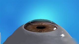 در عمل جراحی( PRK )