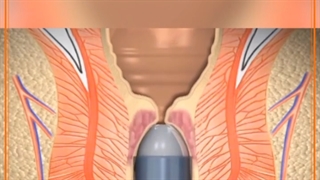 فیلمی از درمان هموروئید