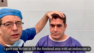 ویدیو جراحی لیفت پیشانی بلافاصله بعد از عمل