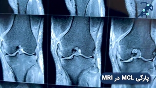 معاینه پارگی MCL