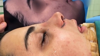 جراحی طبیعی بینی برای مراجعه کننده عزیز