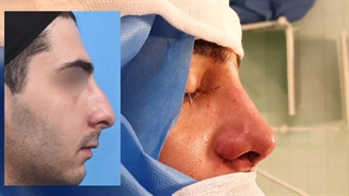جراحی بینی مردانه کاملا طبیعی و متناسب با چهره
