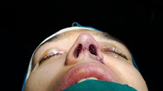 جراحی بینی طبیعی متناسب با چهره