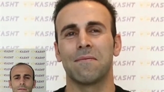 نتیجه کاشت بعد از یکسال- کلینیک vip تهران