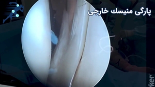 ترمیم منیسک خارجی