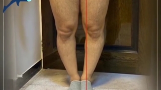 اصلاح زانو پرانتزی دو طرفه