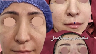 عمل ترکیبی رویژن راینوپلاستی و لیفت شقیقه همزمان