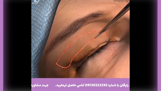 جراحی پلک