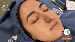 اتمام جراحی زیبایی بینی