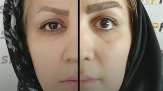 برداشتن پف پشت پلک-کلینیک vip تهران