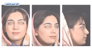 جراحی رینوپلاستی طبیعی متناسب با فرم صورت