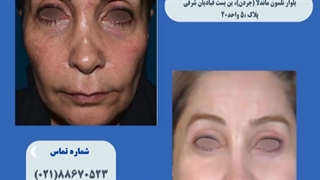 جراحی بلفاروپلاستی