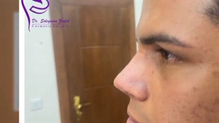 فیلم یک ماه پس از جراحی بینی